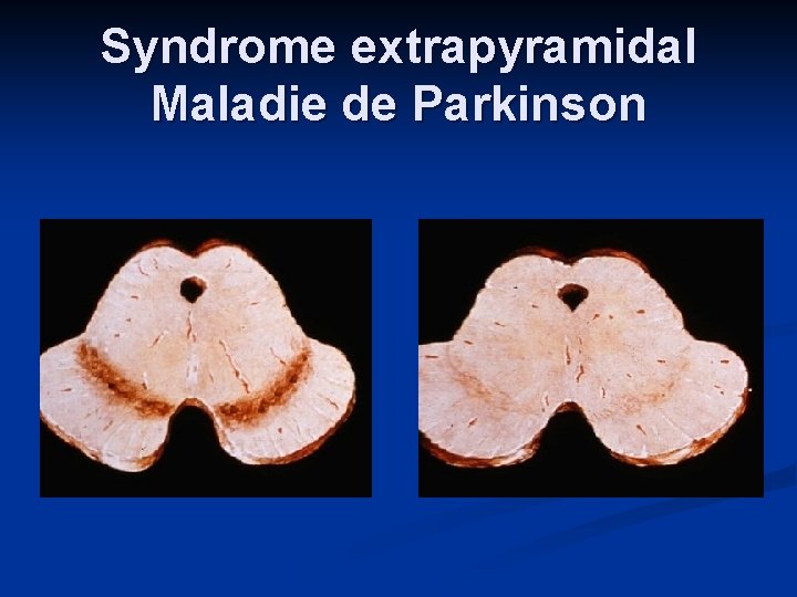Syndrome extrapyramidal Maladie de Parkinson 