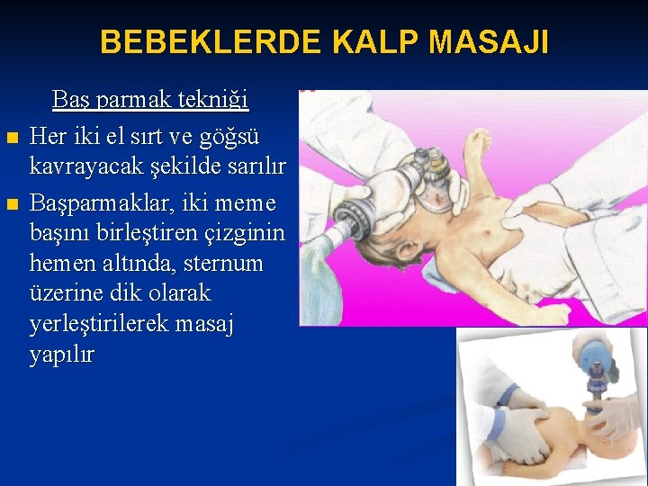 BEBEKLERDE KALP MASAJI n n Baş parmak tekniği Her iki el sırt ve göğsü