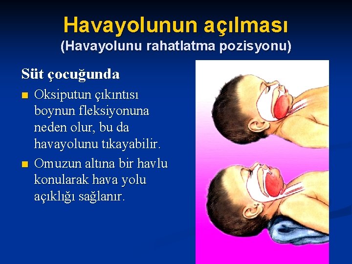 Havayolunun açılması (Havayolunu rahatlatma pozisyonu) Süt çocuğunda n n Oksiputun çıkıntısı boynun fleksiyonuna neden