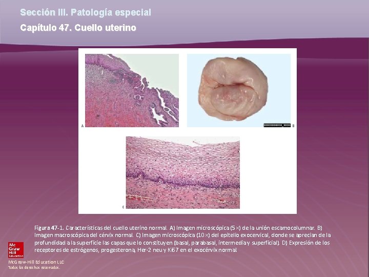 Sección III. Patología especial Capítulo 47. Cuello uterino Figura 47 -1. Características del cuello Sección III. Patología especial Capítulo 47. Cuello uterino Figura 47 -1. Características del cuello