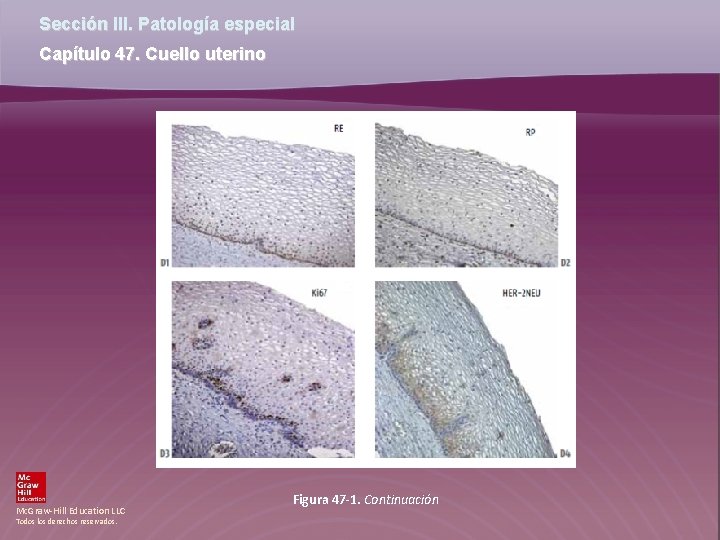 Sección III. Patología especial Capítulo 47. Cuello uterino Mc. Graw-Hill Education LLC Todos los Sección III. Patología especial Capítulo 47. Cuello uterino Mc. Graw-Hill Education LLC Todos los
