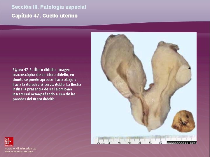 Sección III. Patología especial Capítulo 47. Cuello uterino Figura 47 -2. Útero didelfo. Imagen Sección III. Patología especial Capítulo 47. Cuello uterino Figura 47 -2. Útero didelfo. Imagen