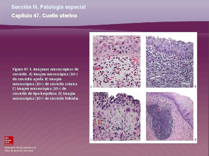Sección III. Patología especial Capítulo 47. Cuello uterino Figura 47 -3. Imágenes microscópicas de Sección III. Patología especial Capítulo 47. Cuello uterino Figura 47 -3. Imágenes microscópicas de