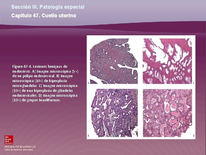 Sección III. Patología especial Capítulo 47. Cuello uterino Figura 47 -4. Lesiones benignas de Sección III. Patología especial Capítulo 47. Cuello uterino Figura 47 -4. Lesiones benignas de