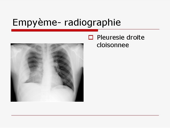 Empyème- radiographie o Pleuresie droite cloisonnee 