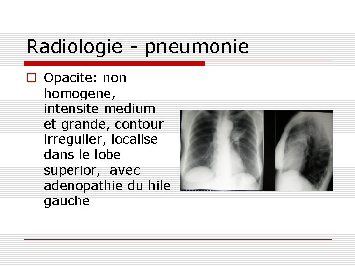 Radiologie - pneumonie o Opacite: non homogene, intensite medium et grande, contour irregulier, localise