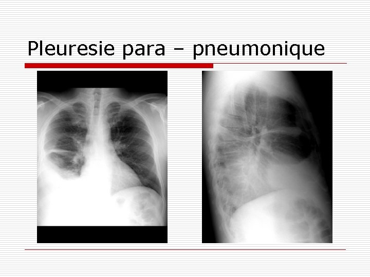 Pleuresie para – pneumonique 