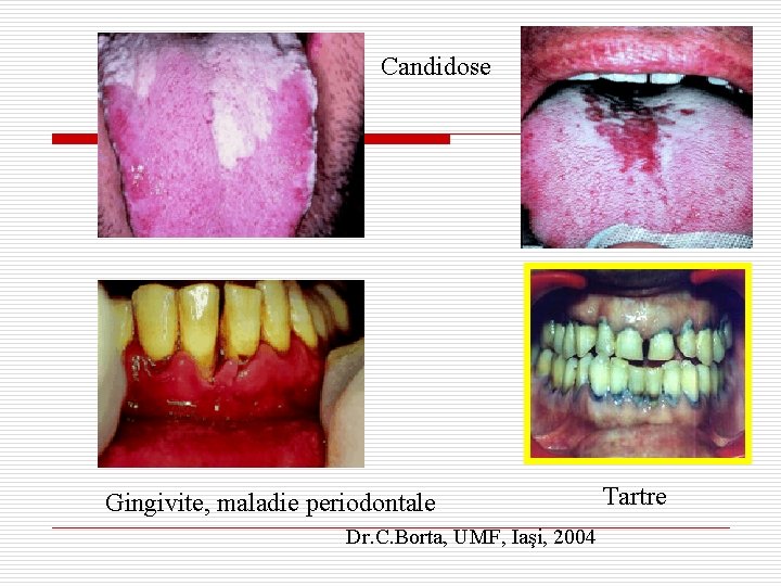 Candidose Gingivite, maladie periodontale Dr. C. Borta, UMF, Iaşi, 2004 Tartre 