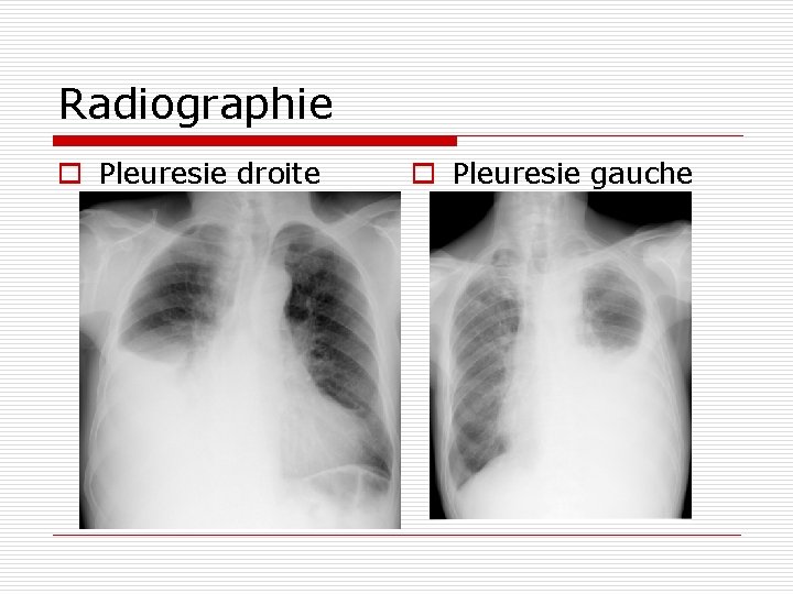 Radiographie o Pleuresie droite o Pleuresie gauche 