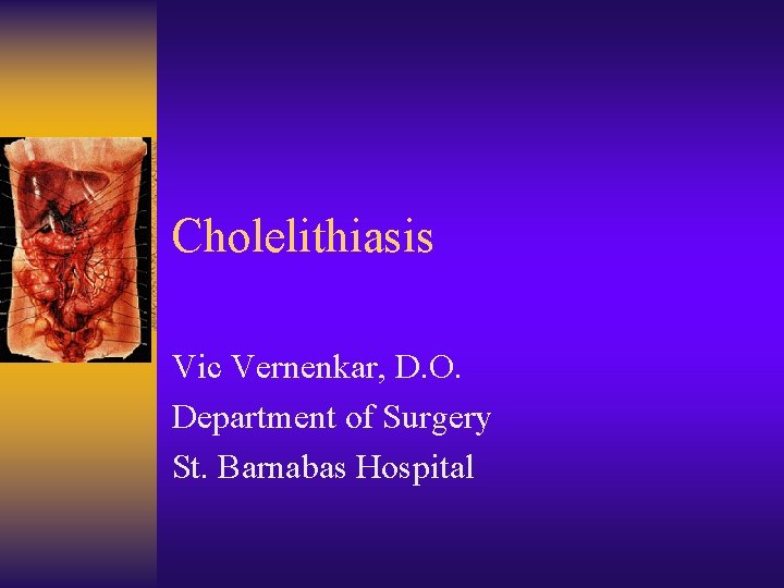 Cholelithiasis Vic Vernenkar, D. O. Department of Surgery St. Barnabas Hospital 