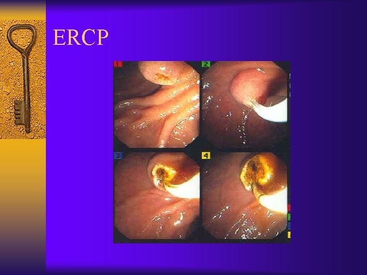 ERCP 