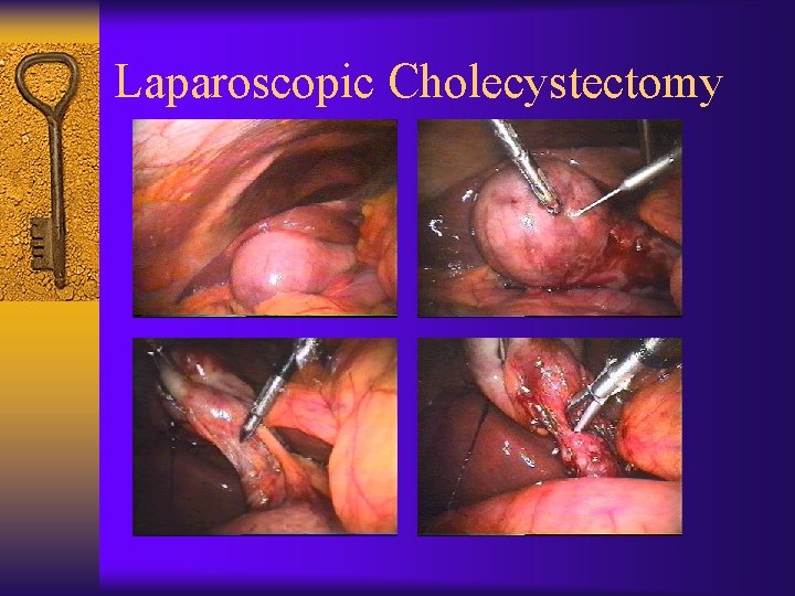 Laparoscopic Cholecystectomy 