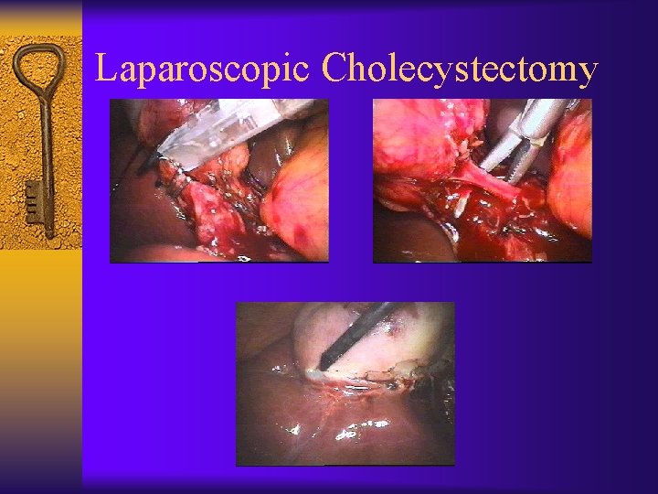 Laparoscopic Cholecystectomy 