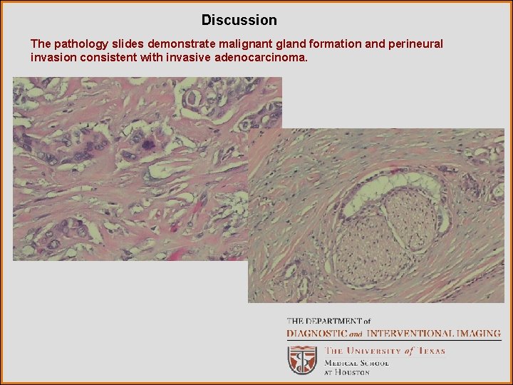 Discussion The pathology slides demonstrate malignant gland formation and perineural invasion consistent with invasive