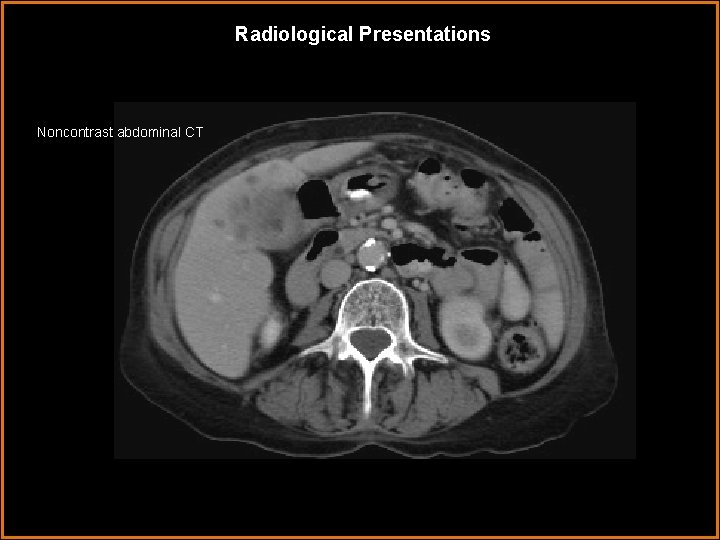 Radiological Presentations Noncontrast abdominal CT 