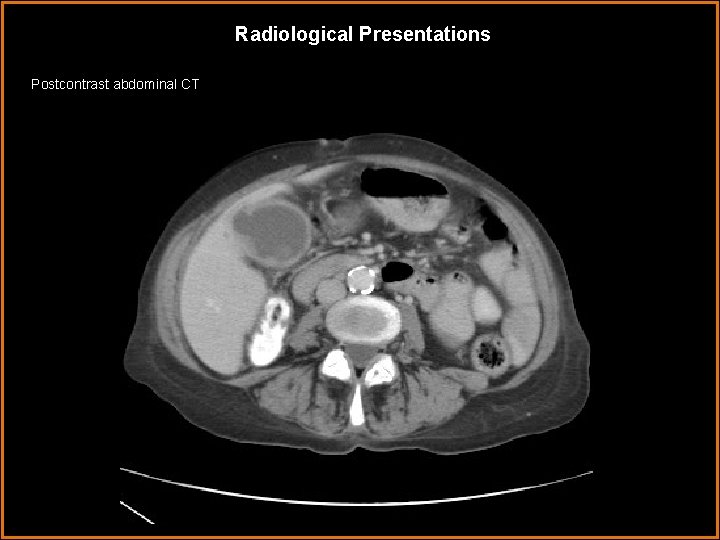 Radiological Presentations Postcontrast abdominal CT 