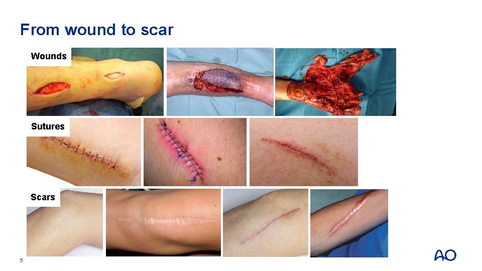 From wound to scar Wounds Sutures Scars 5 From wound to scar Wounds Sutures Scars 5