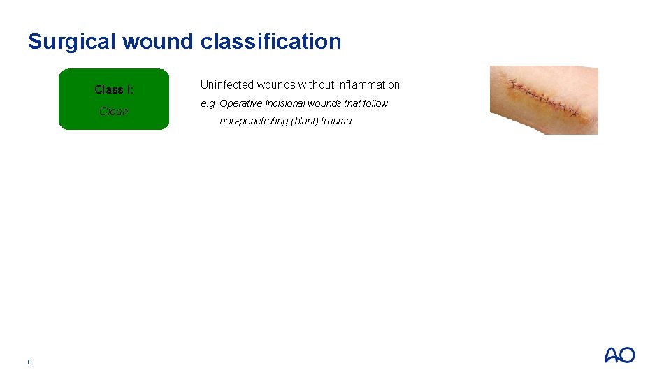 Surgical wound classification Class I: Clean 6 Uninfected wounds without inflammation e. g. Operative