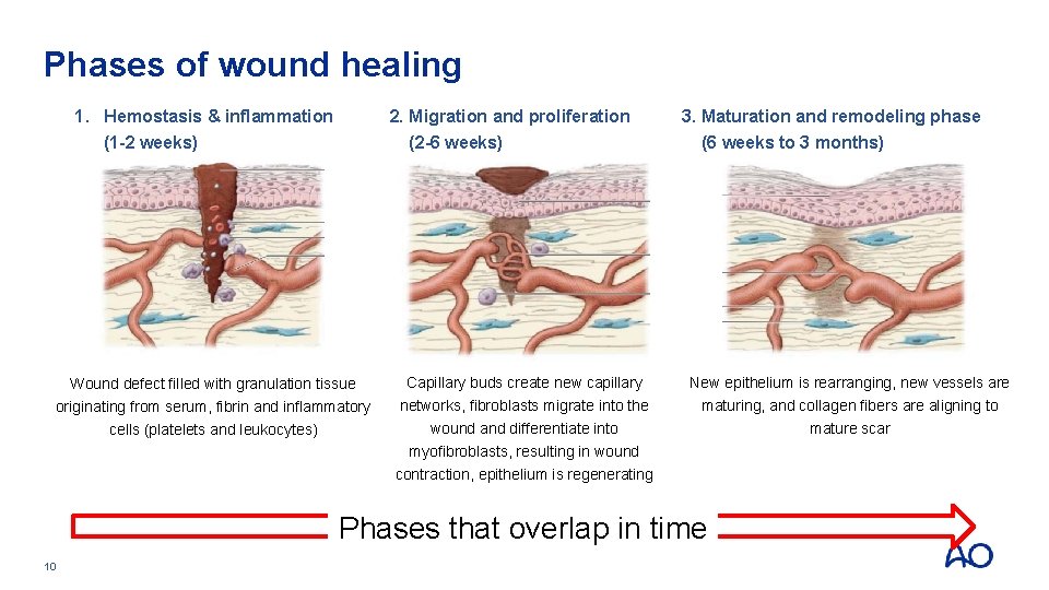 Phases of wound healing 1. Hemostasis & inflammation (1 -2 weeks) 2. Migration and