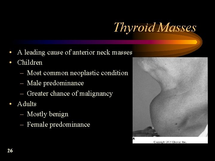 Thyroid Masses • A leading cause of anterior neck masses • Children – Most