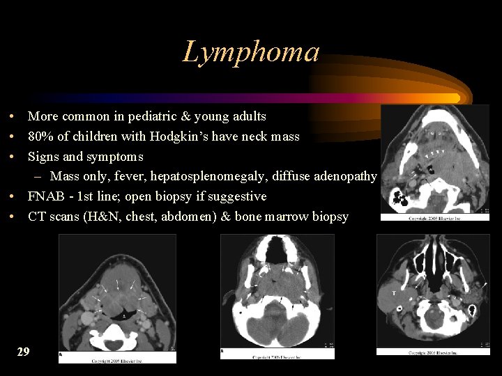 Lymphoma • More common in pediatric & young adults • 80% of children with