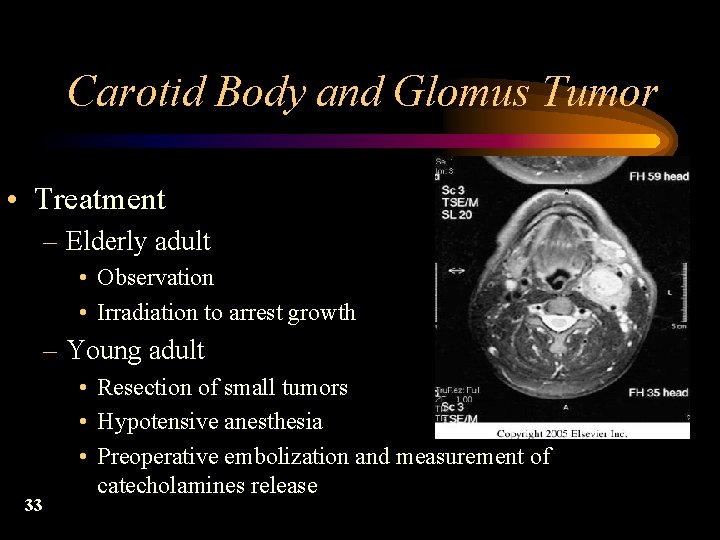 Carotid Body and Glomus Tumor • Treatment – Elderly adult • Observation • Irradiation