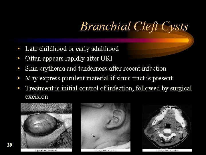 Branchial Cleft Cysts • • • 39 Late childhood or early adulthood Often appears