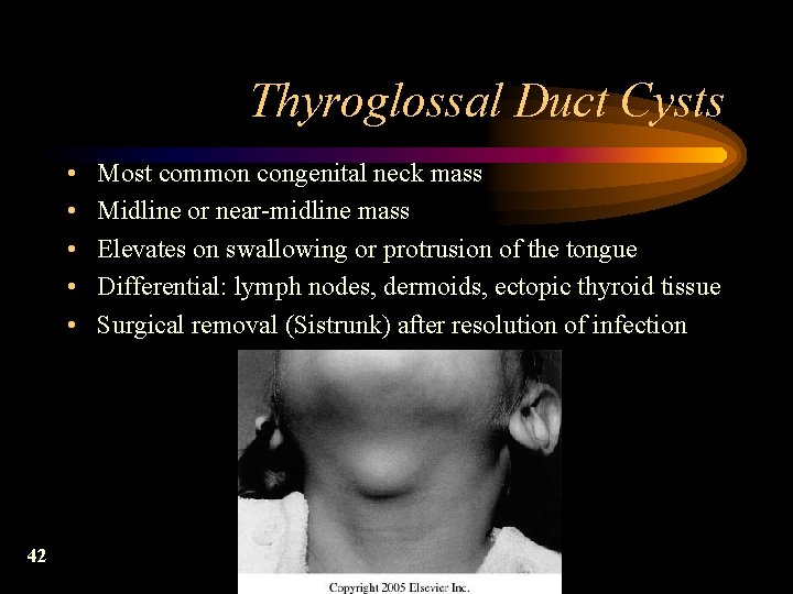 Thyroglossal Duct Cysts • • • 42 Most common congenital neck mass Midline or