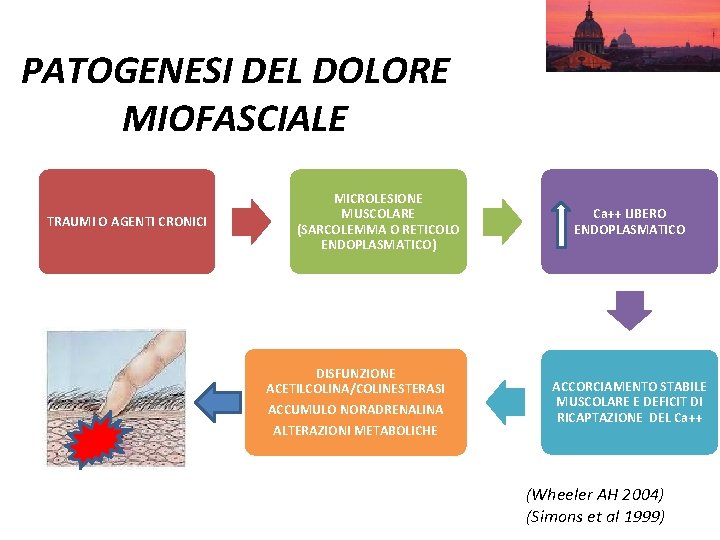 PATOGENESI DEL DOLORE MIOFASCIALE TRAUMI O AGENTI CRONICI MICROLESIONE MUSCOLARE (SARCOLEMMA O RETICOLO ENDOPLASMATICO)