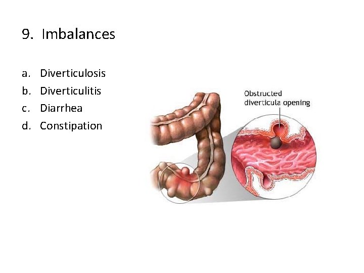 9. Imbalances a. b. c. d. Diverticulosis Diverticulitis Diarrhea Constipation 