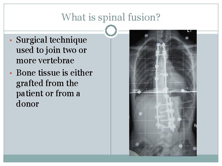 What is spinal fusion? • Surgical technique used to join two or more vertebrae