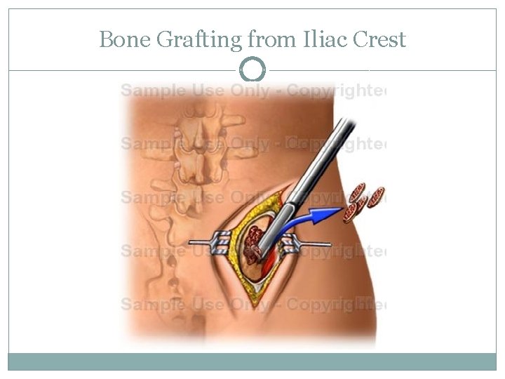 Bone Grafting from Iliac Crest 