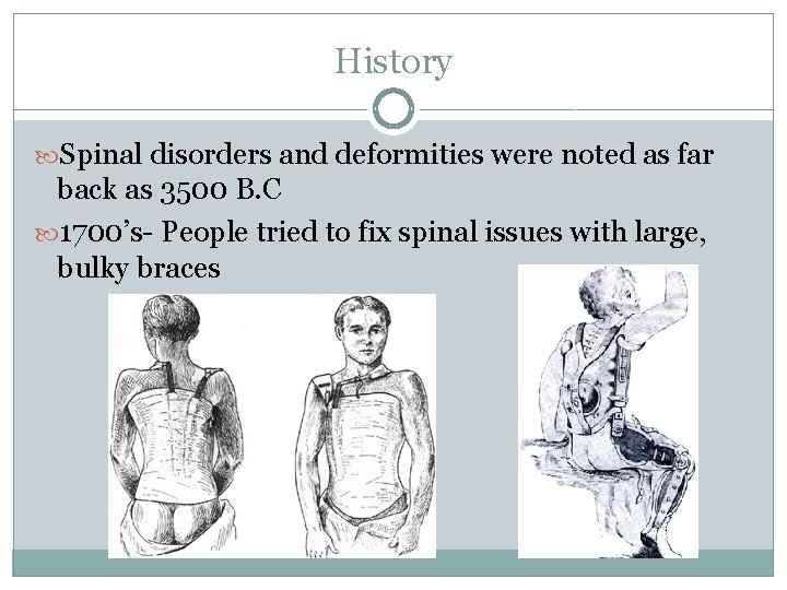 History Spinal disorders and deformities were noted as far back as 3500 B. C