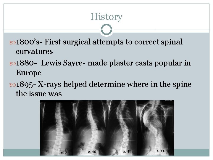 History 1800’s- First surgical attempts to correct spinal curvatures 1880 - Lewis Sayre- made