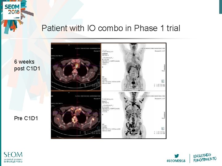 Patient with IO combo in Phase 1 trial 6 weeks post C 1 D