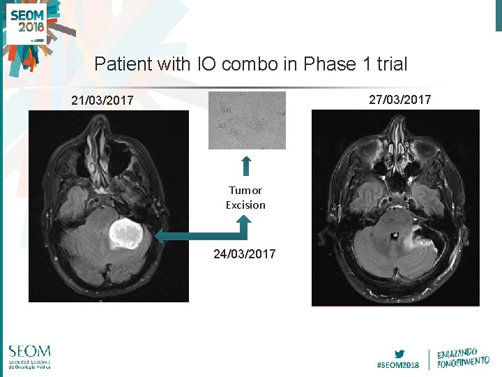 Patient with IO combo in Phase 1 trial 27/03/2017 21/03/2017 Tumor Excision 24/03/2017 #SEOM