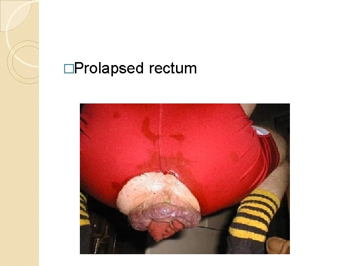 �Prolapsed rectum 