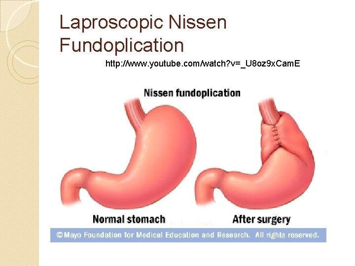 Laproscopic Nissen Fundoplication http: //www. youtube. com/watch? v=_U 8 oz 9 x. Cam. E