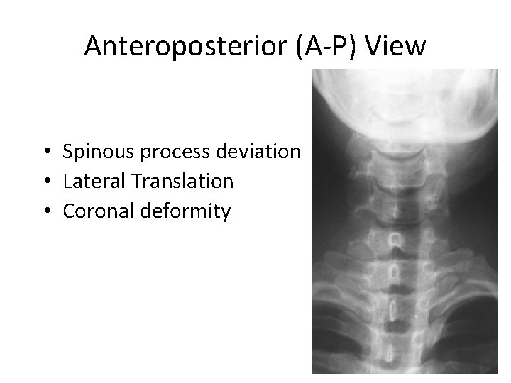 Anteroposterior (A-P) View • Spinous process deviation • Lateral Translation • Coronal deformity 