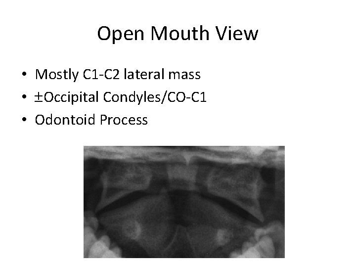 Open Mouth View • Mostly C 1 -C 2 lateral mass • Occipital Condyles/CO-C