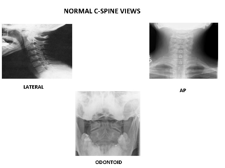 NORMAL C-SPINE VIEWS LATERAL AP ODONTOID 