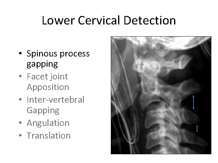 Lower Cervical Detection • Spinous process gapping • Facet joint Apposition • Inter-vertebral Gapping