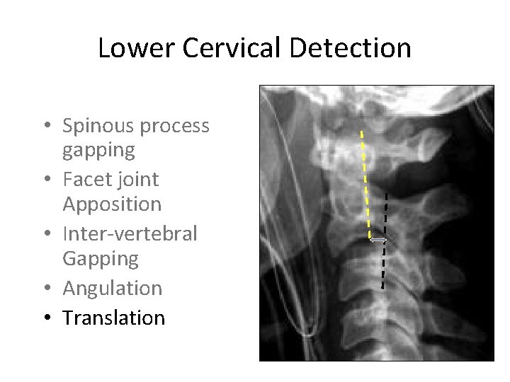 Lower Cervical Detection • Spinous process gapping • Facet joint Apposition • Inter-vertebral Gapping