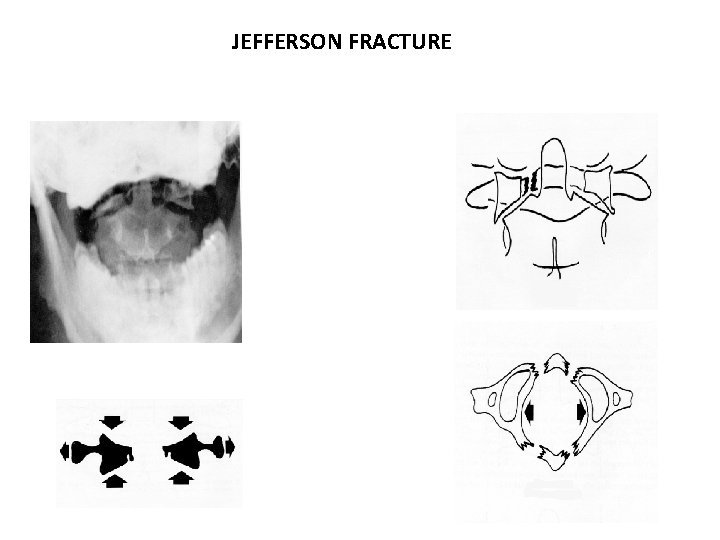 JEFFERSON FRACTURE 