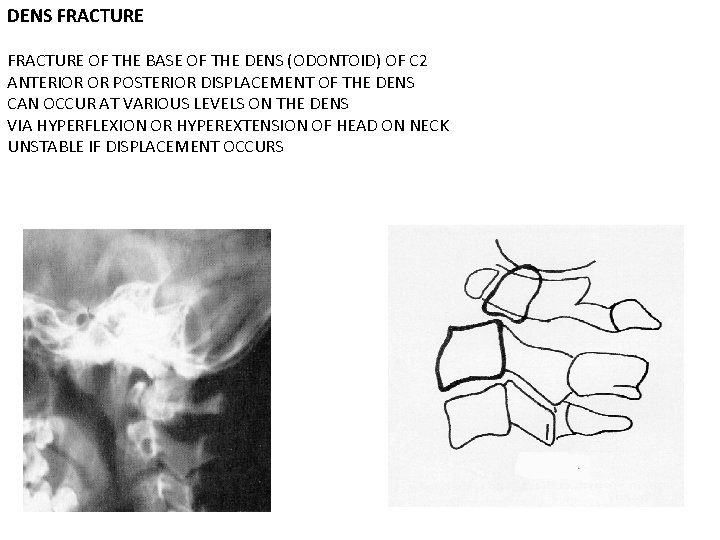 DENS FRACTURE OF THE BASE OF THE DENS (ODONTOID) OF C 2 ANTERIOR OR