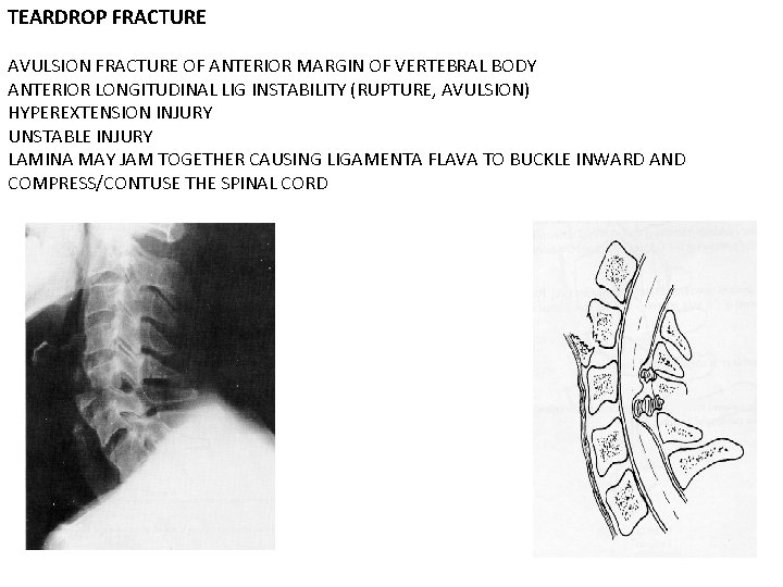 TEARDROP FRACTURE AVULSION FRACTURE OF ANTERIOR MARGIN OF VERTEBRAL BODY ANTERIOR LONGITUDINAL LIG INSTABILITY