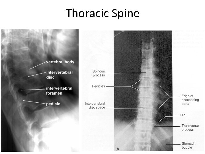 Thoracic Spine 