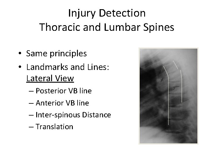 Injury Detection Thoracic and Lumbar Spines • Same principles • Landmarks and Lines: Lateral