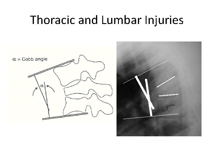 Thoracic and Lumbar Injuries 