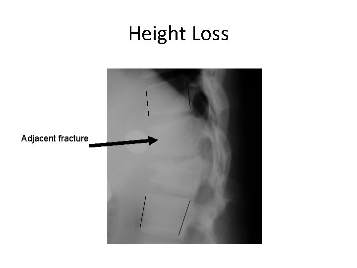 Height Loss Adjacent fracture 